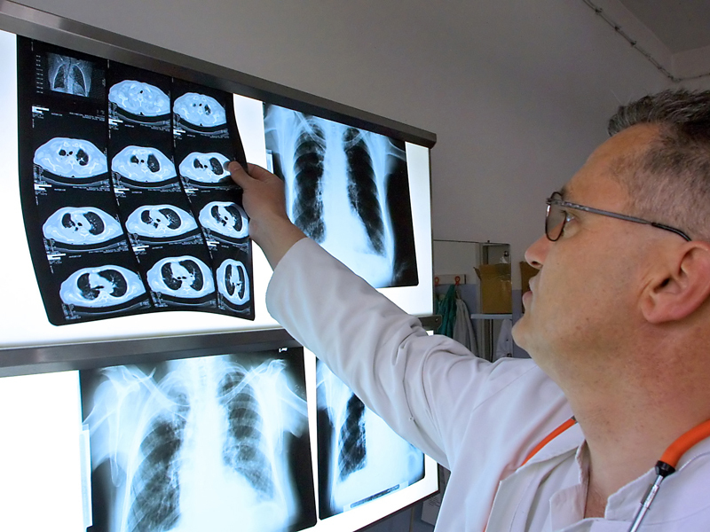 Tratarea cancerului va fi cu 60% mai scumpă în următorii zece ani