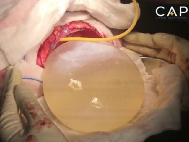 Descoperire șocantă, făcută de medici în interiorul craniului unei fetițe. Are o greutate de aproape jumătate de kilogram