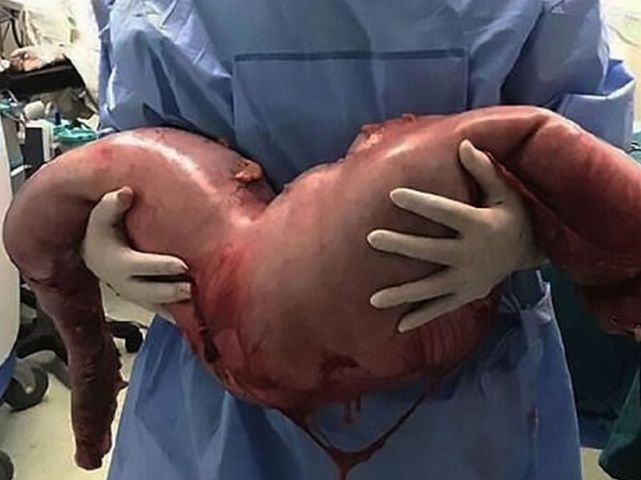 O descoperire a șocat lumea medicală. ''Are 13 kilograme. Nu am mai văzut așa ceva''