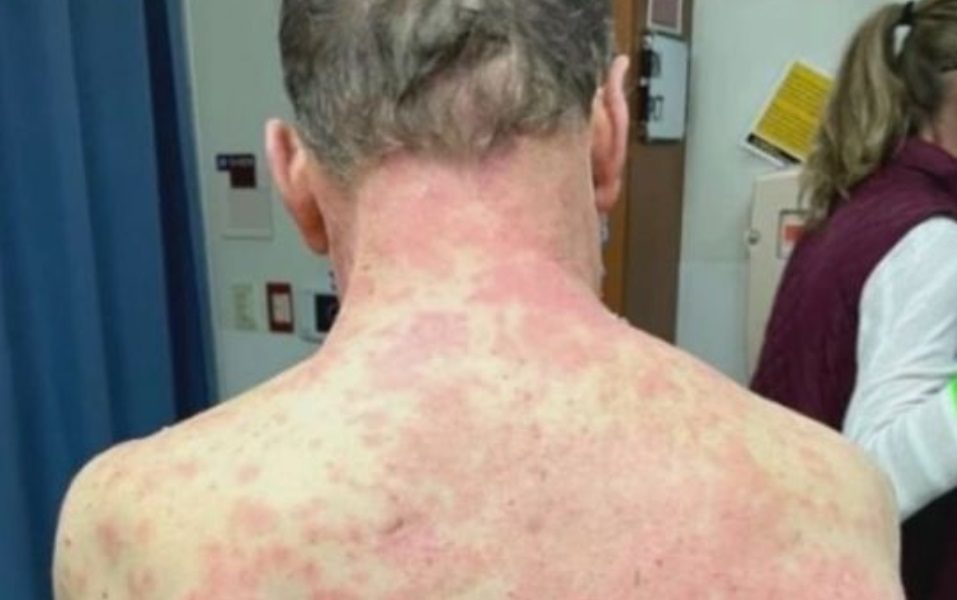 Unui bărbat i-a căzut pielea după ce s-a vaccinat cu Johnson&Johnson: s-a înroșit și a crăpat