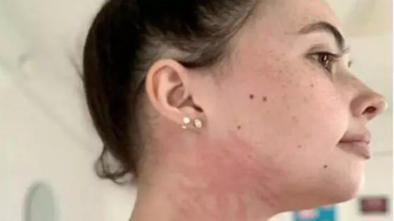Boala rară de care suferă o tănâră în vârstă de 25 de ani: lacrimile îi provoacă răni și bea doar lapte