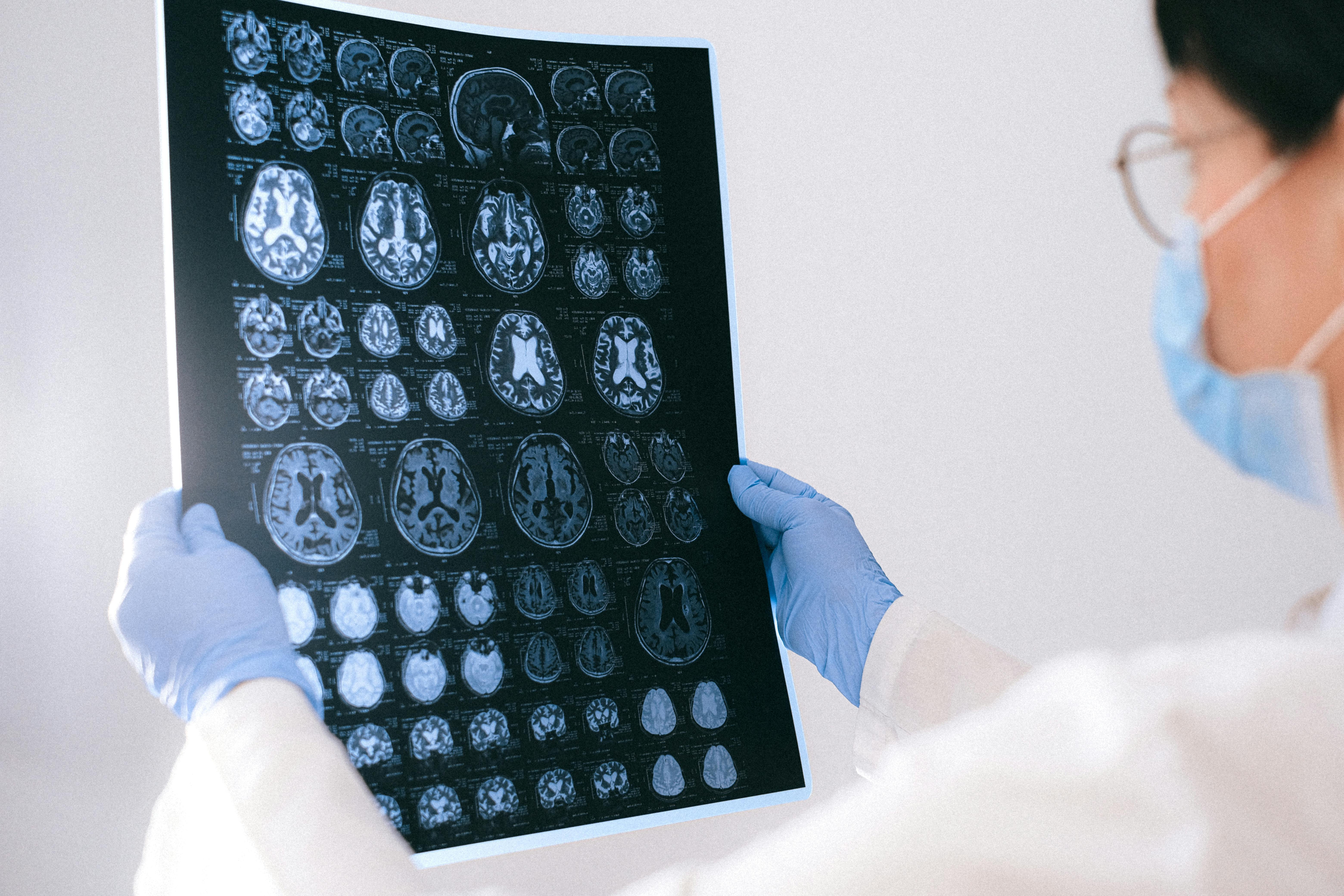 Japonia aprobă un nou medicament pentru Alzheimer