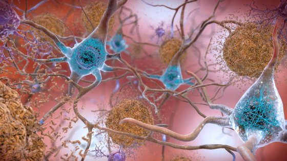 Agenția Europeană a Medicamentului a aprobat un tratament mult-așteptat pentru Alzheimer